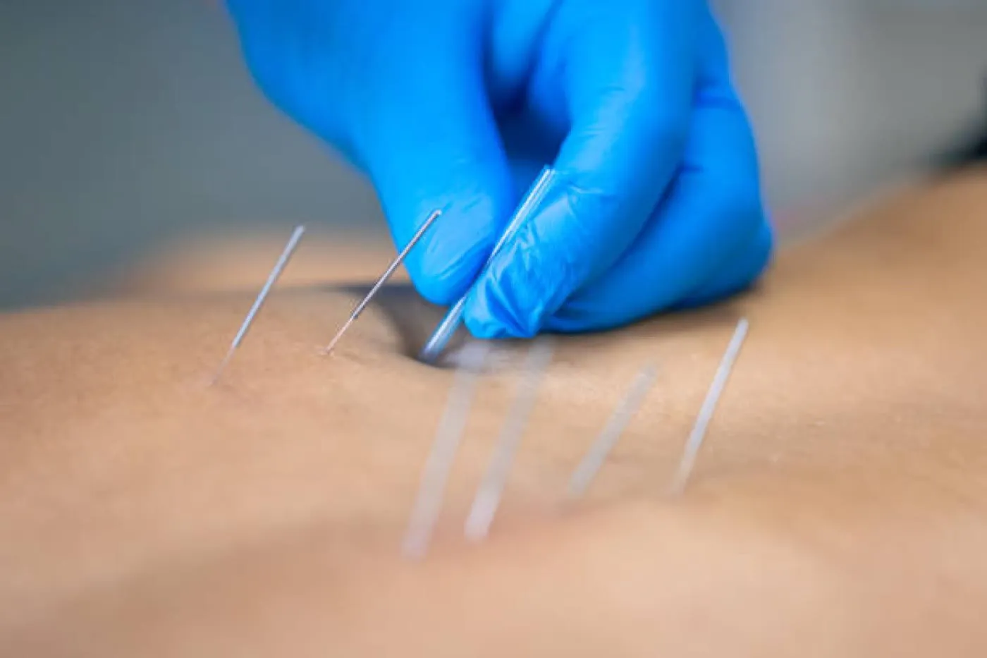 Dry needling applied to a person’s back