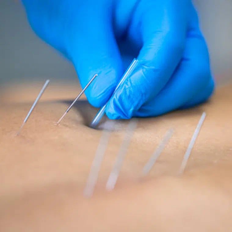 Dry needling therapy treatment